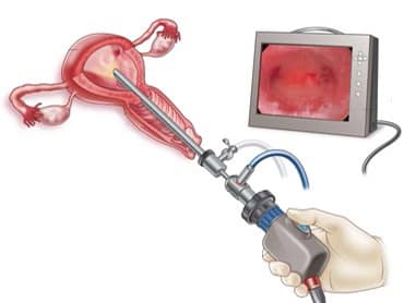 Гістероскопія