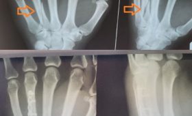 Травматологія